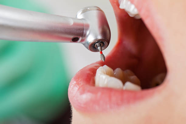 Best Emergency Wisdom Teeth Removal in Country Clu, CA